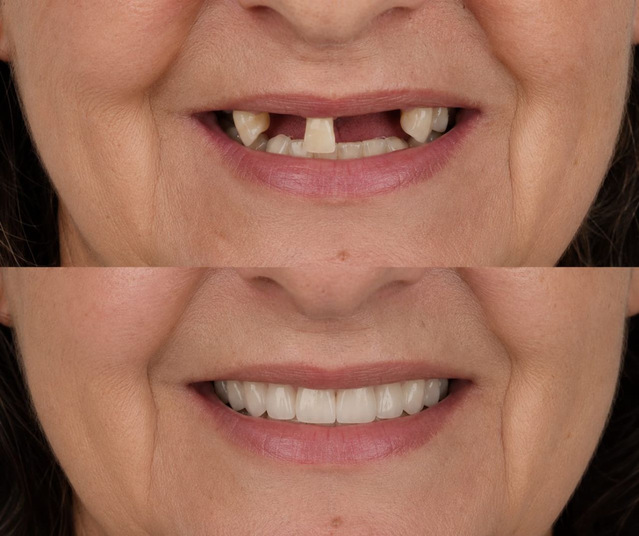 Sorriso reabilitado — Sorriso renovado